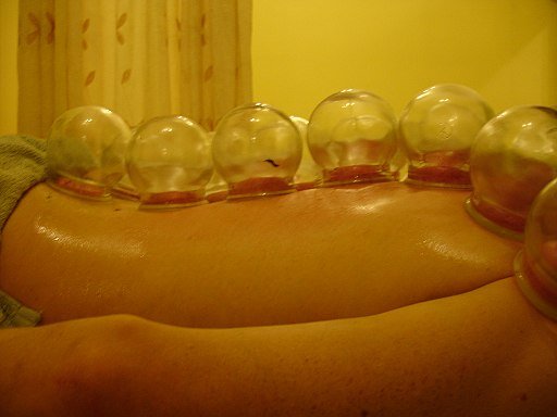 Fire_Cupping_拔罐 Fire_Cupping_拔罐